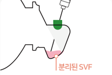 SVF 회수